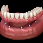 all-on-x dental implant denture on mandible