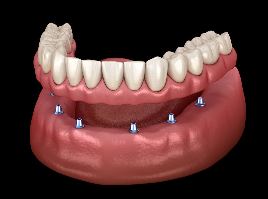all-on-x dental implant denture on mandible