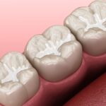 dental sealants on molar teeth to prevent cavities