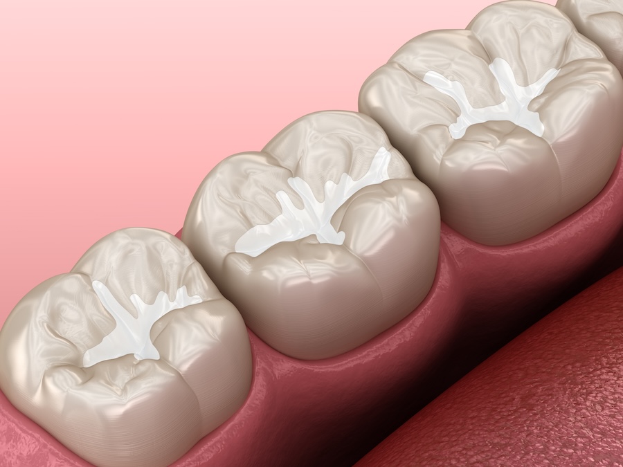 dental sealants on molar teeth to prevent cavities